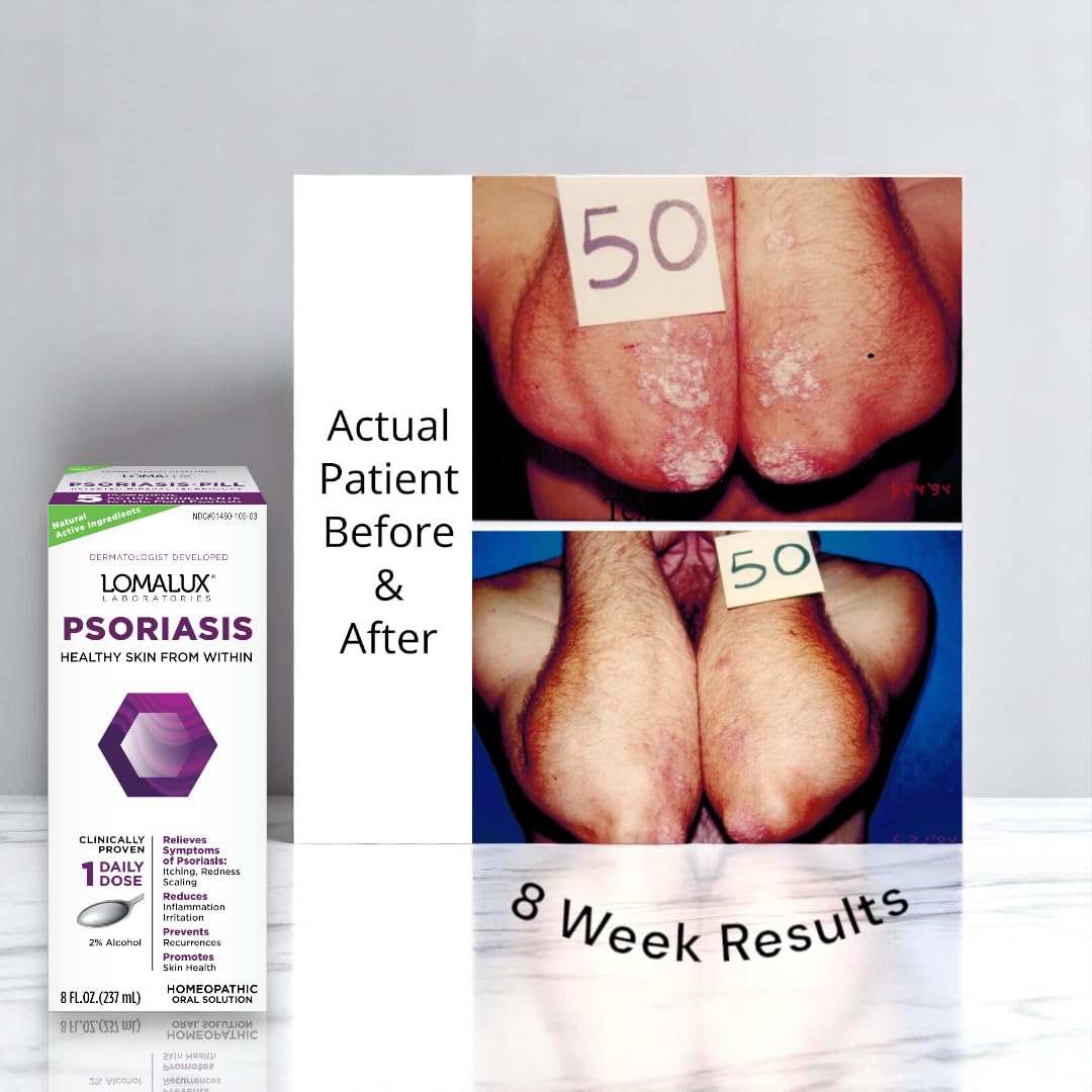 8 oz Psoriasis & Seborrheic Dermatitis Relief X6274